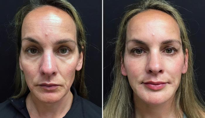 Injectables & Fillers Before & After Case 26790