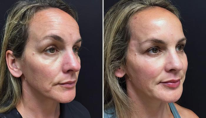 Injectables & Fillers Before & After Case 26790