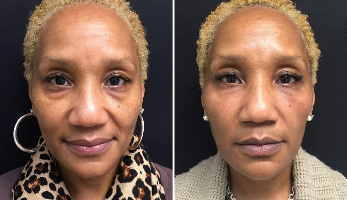 Injectables & Fillers Before & After Case 28299