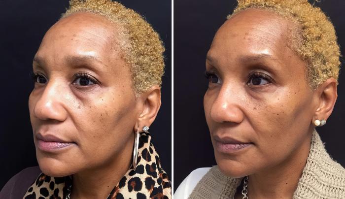 Injectables & Fillers Before & After Case 28299