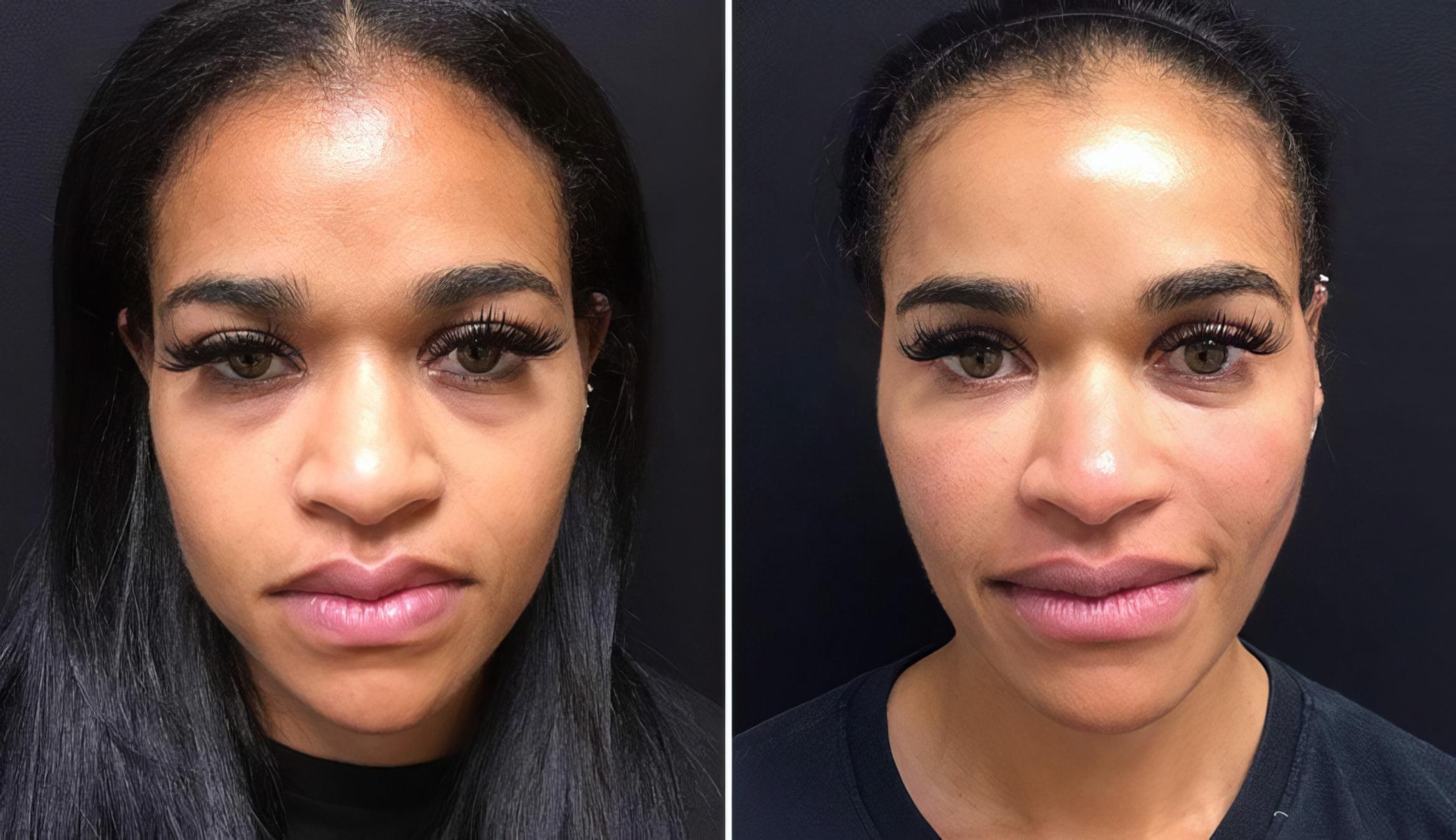 Injectables & Fillers Before & After Case 28305