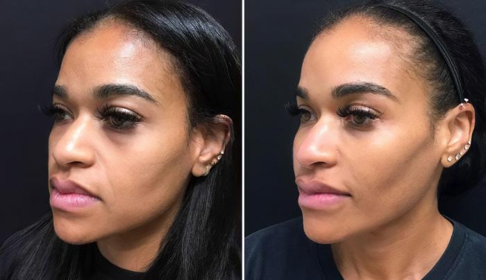 Injectables & Fillers Before & After Case 28305