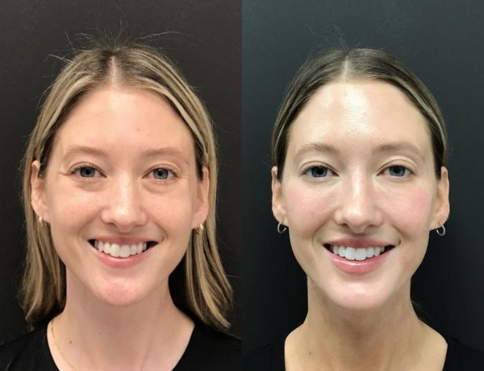 Injectables & Fillers Before & After Case 28317