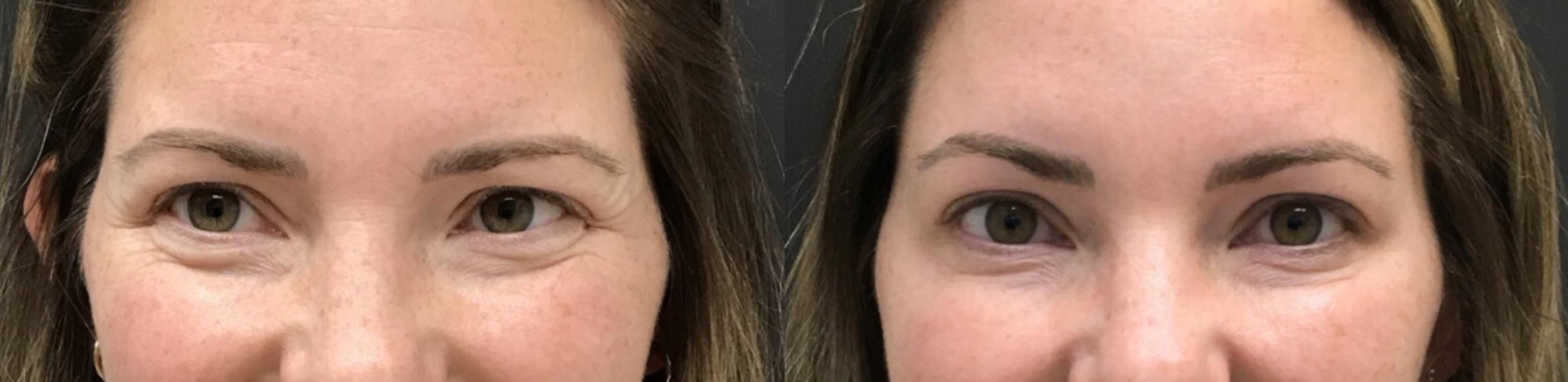 Injectables & Fillers Before & After Case 28318