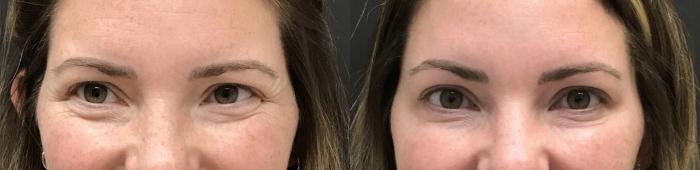 Injectables & Fillers Before & After Case 28318