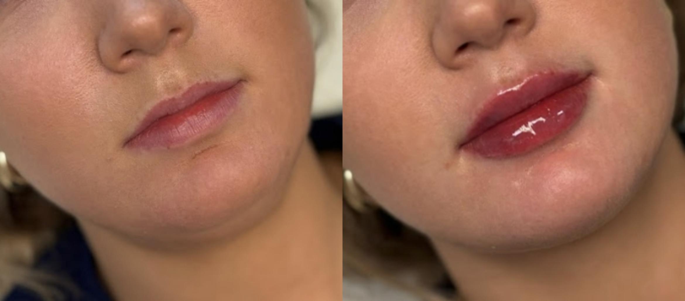 Injectables & Fillers Before & After Case 28320