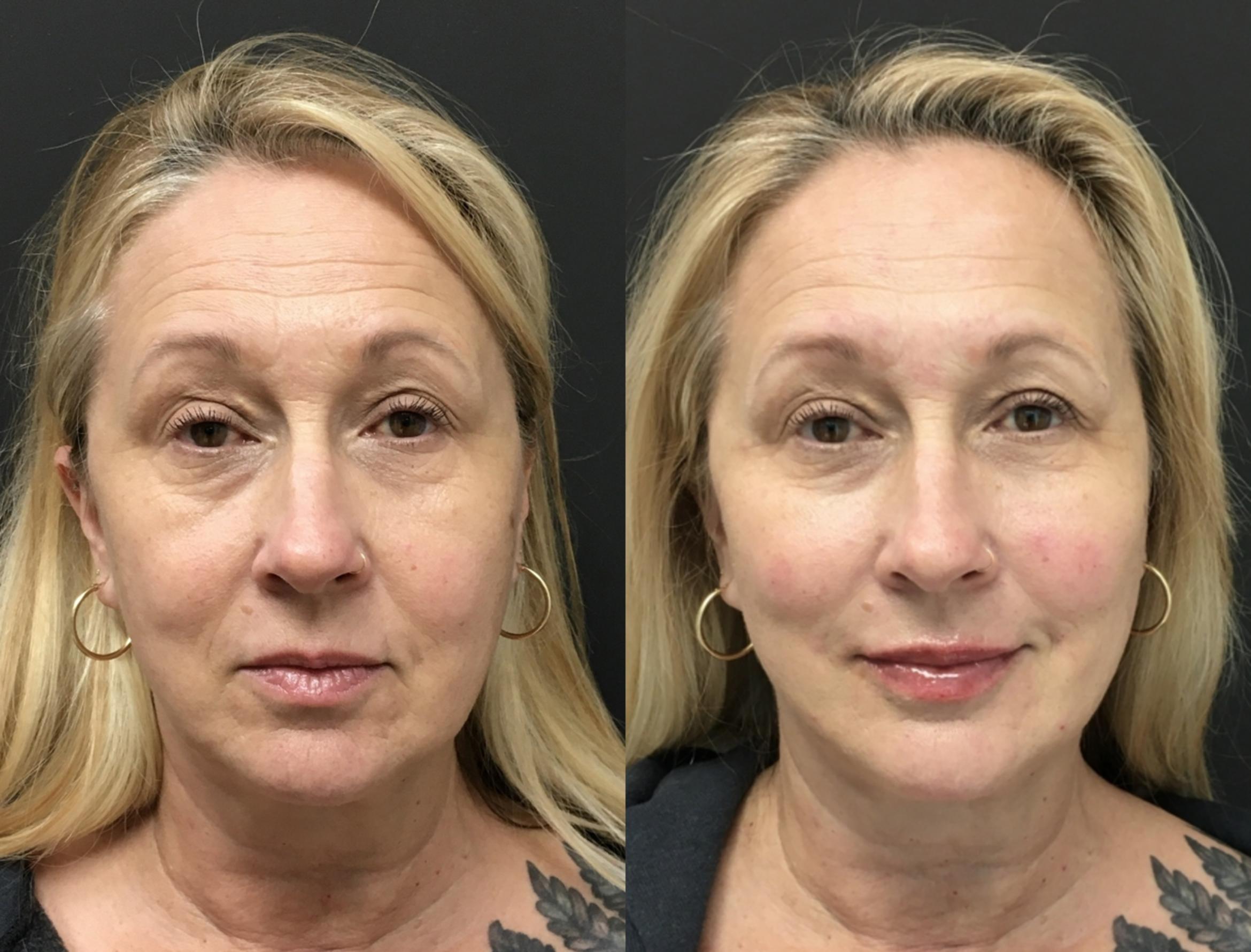 Injectables & Fillers Before & After Case 28321
