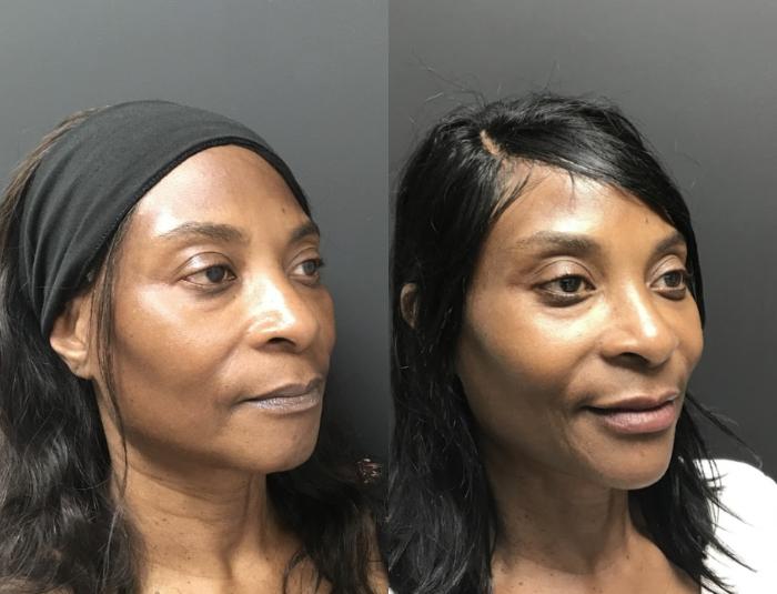 Injectables & Fillers Before & After Case 28322
