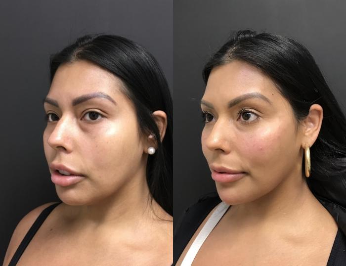 Injectables & Fillers Before & After Case 28323