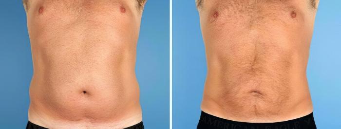 Liposuction Before & After Case 17520