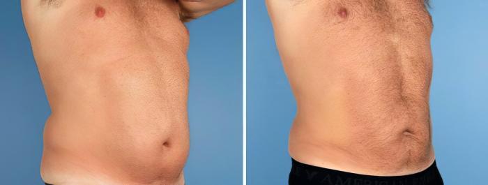 Liposuction Before & After Case 17520