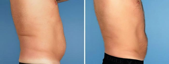 Liposuction Before & After Case 17520