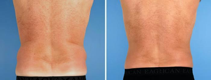 Liposuction Before & After Case 17520