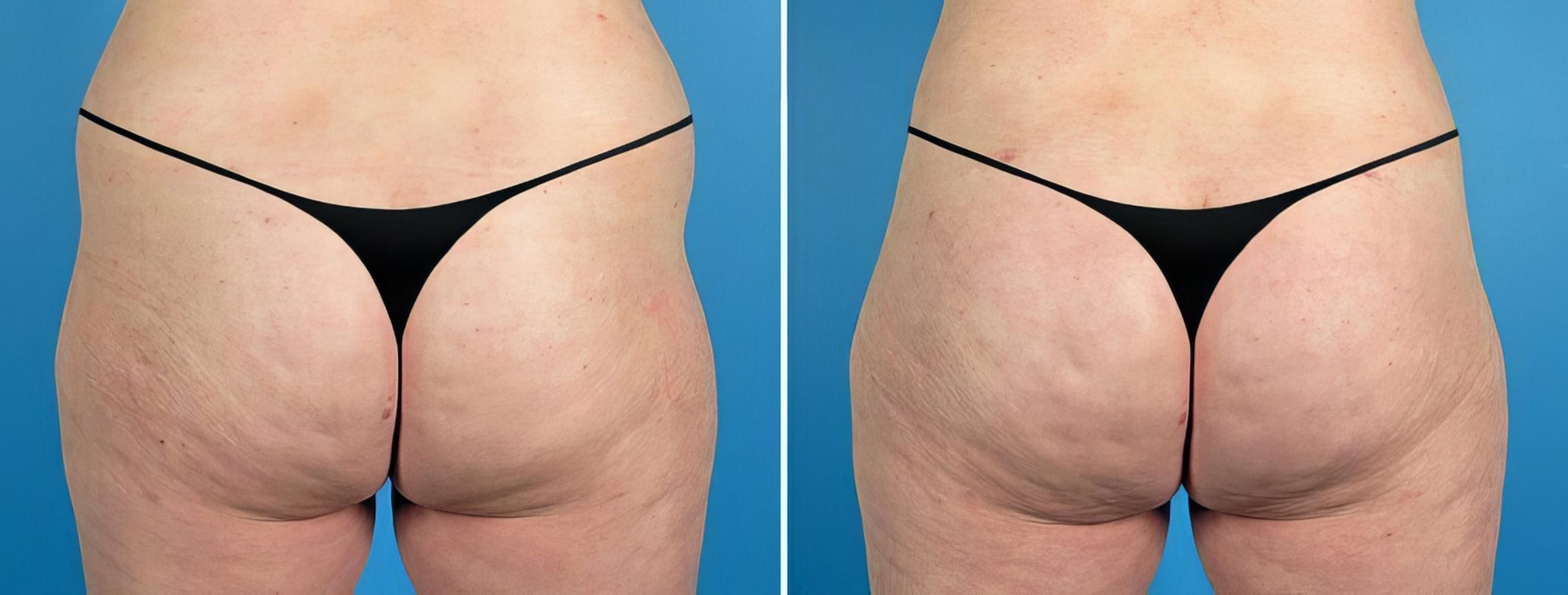 Liposuction Before & After Case 17525