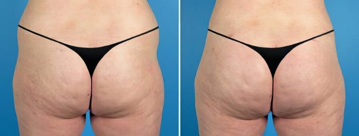 Liposuction Before & After Case 17525