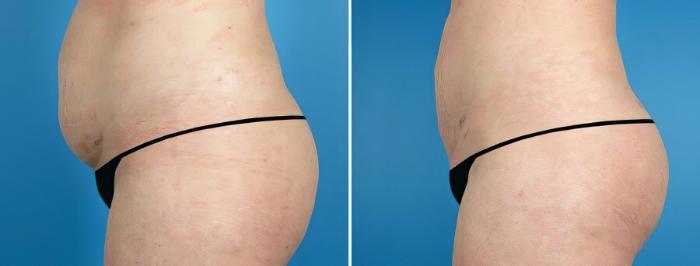 Liposuction Before & After Case 17525