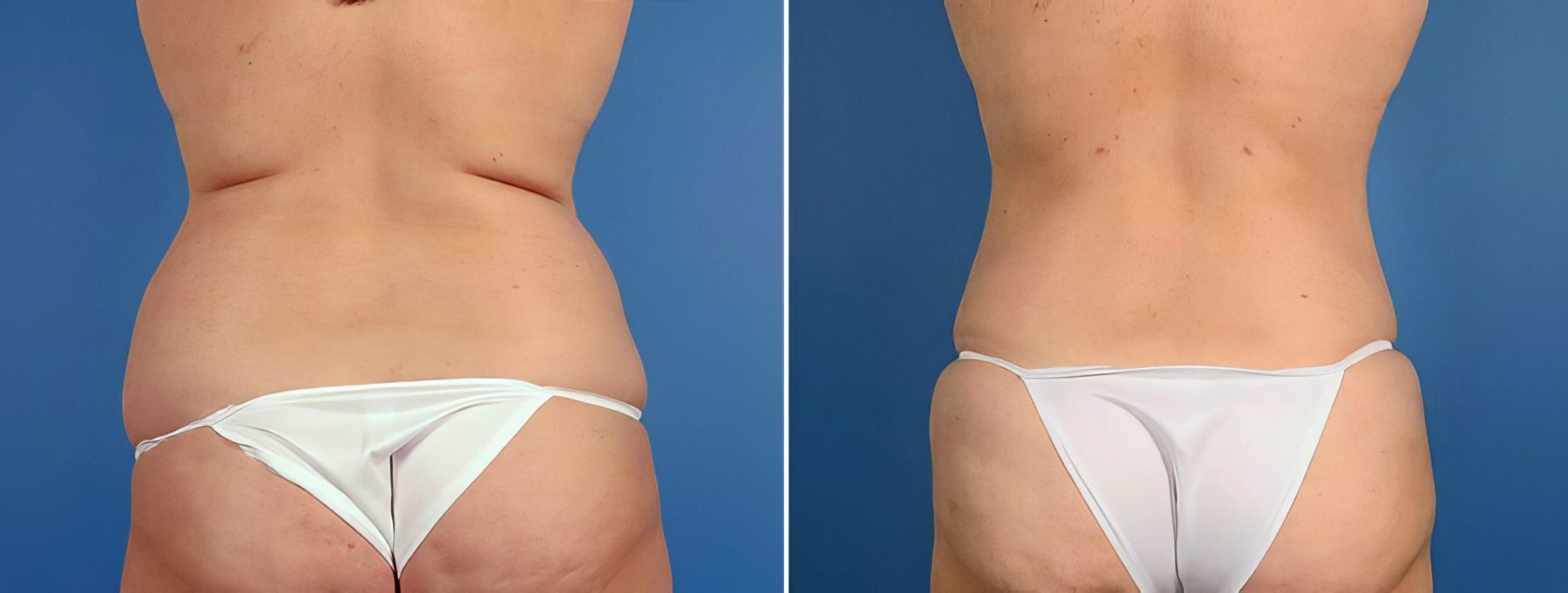 Liposuction Before & After Case 17528