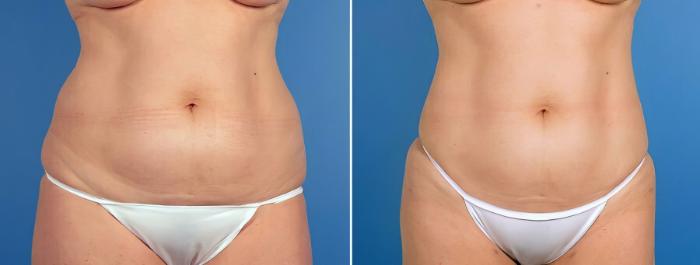 Liposuction Before & After Case 17528