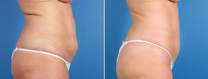 Liposuction Before & After Case 17528