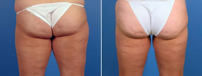 Liposuction Before & After Case 17528