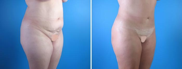Liposuction Before & After Case 17969