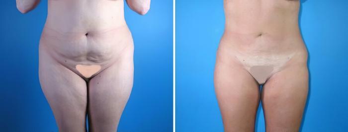 Liposuction Before & After Case 17969