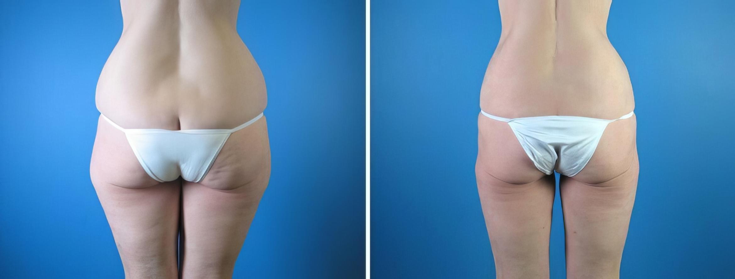 Liposuction Before & After Case 17975