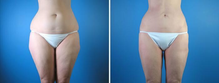Liposuction Before & After Case 17975