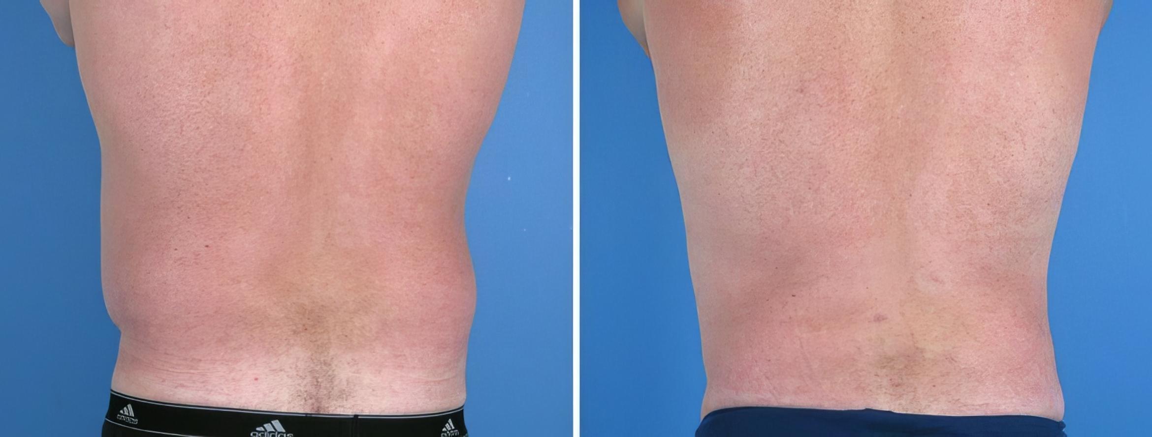 Liposuction Before & After Case 17978