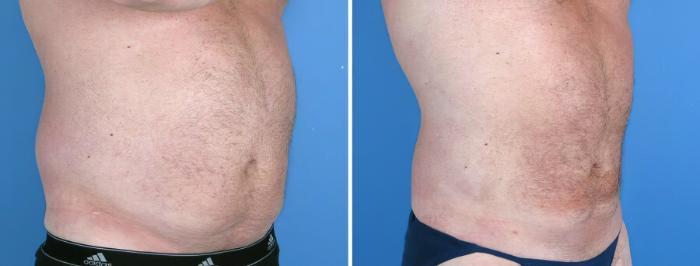 Liposuction Before & After Case 17978