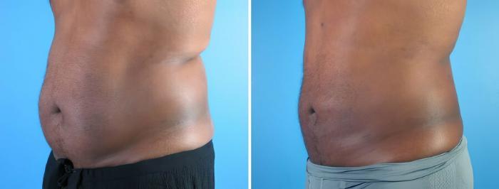 Liposuction Before & After Case 17988