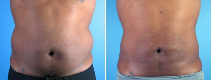 Liposuction Before & After Case 17988