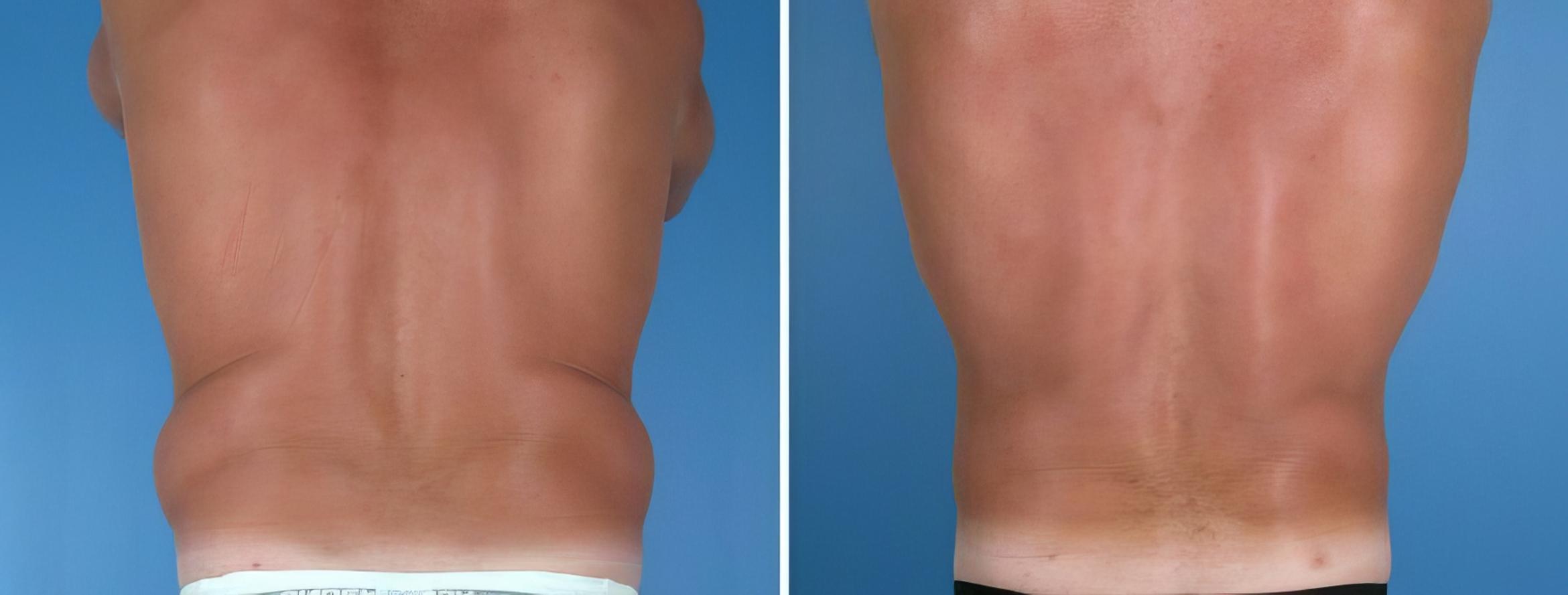 Liposuction Before & After Case 17991