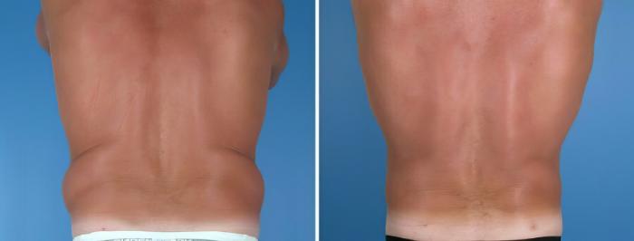 Liposuction Before & After Case 17991