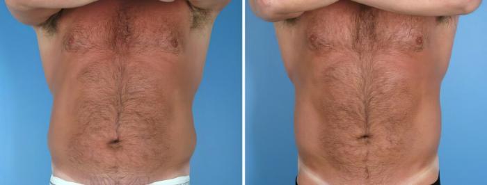 Liposuction Before & After Case 17991
