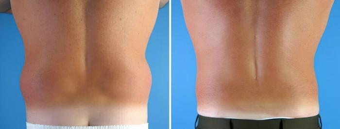 Liposuction Before & After Case 17999