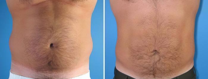 Liposuction Before & After Case 17999
