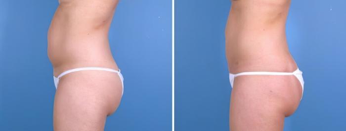Liposuction Before & After Case 18002