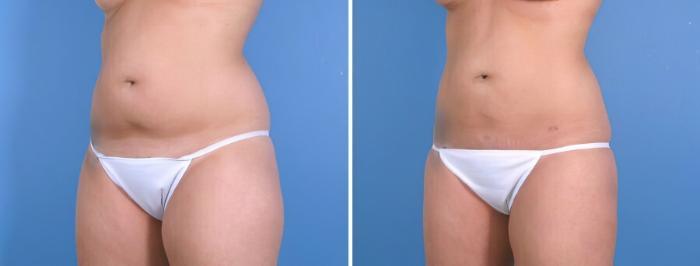 Liposuction Before & After Case 18002