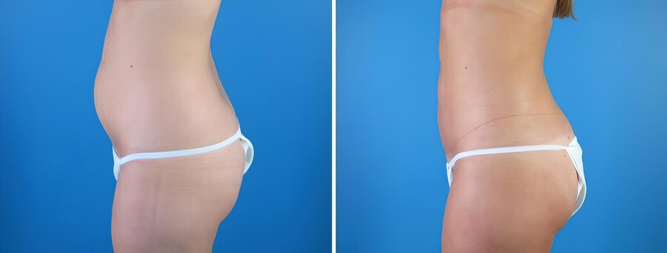 Liposuction Before & After Case 18005