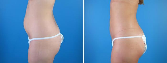 Liposuction Before & After Case 18005