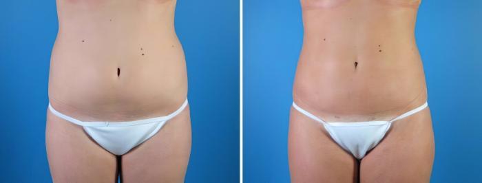 Liposuction Before & After Case 18005