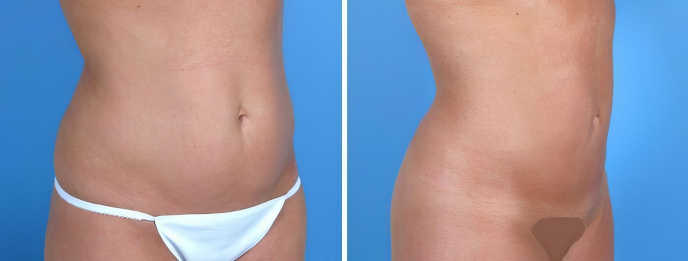 Liposuction Before & After Case 18011