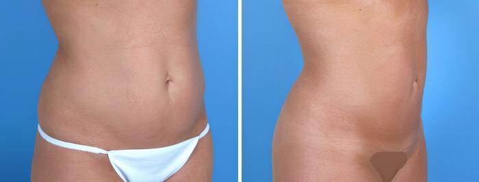 Liposuction Before & After Case 18011
