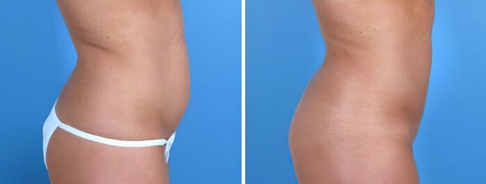 Liposuction Before & After Case 18011