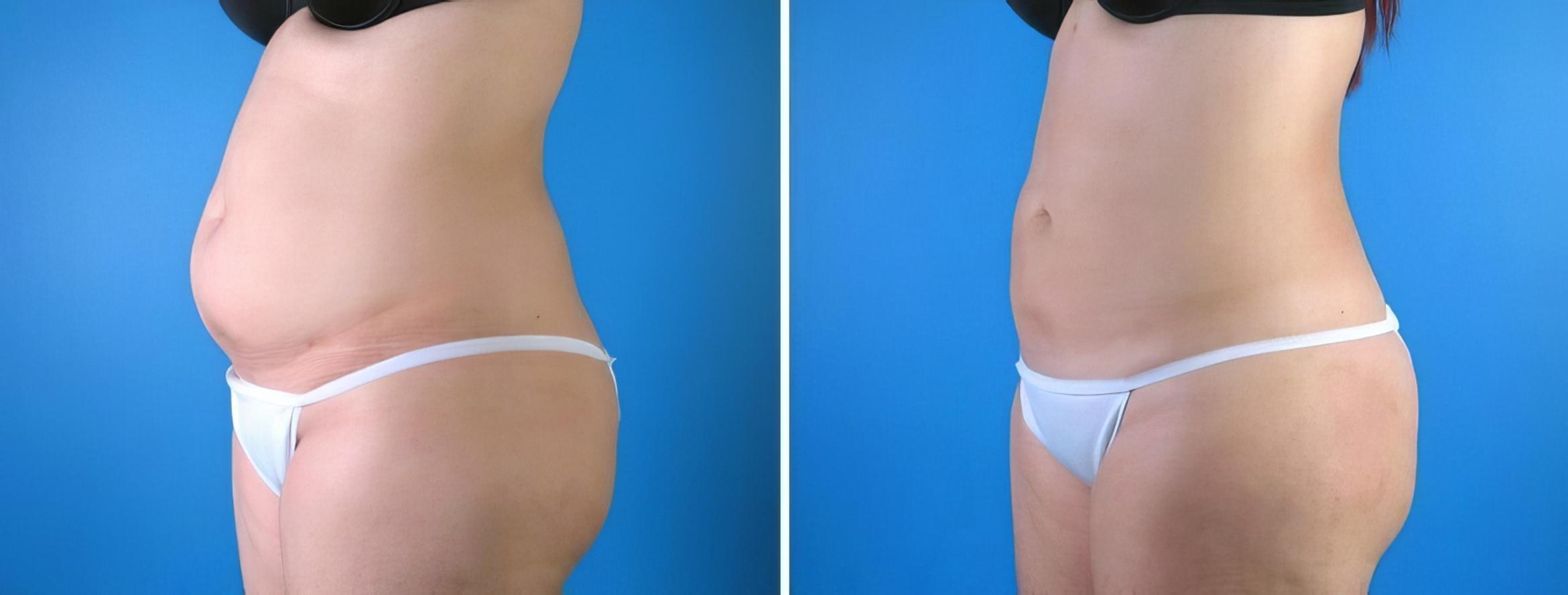 Liposuction Before & After Case 18020