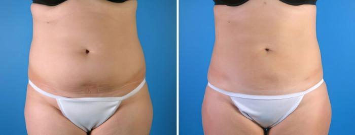 Liposuction Before & After Case 18020