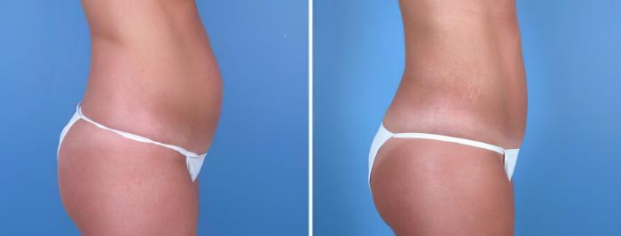 Liposuction Before & After Case 18026