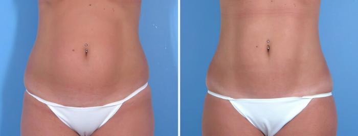 Liposuction Before & After Case 18026