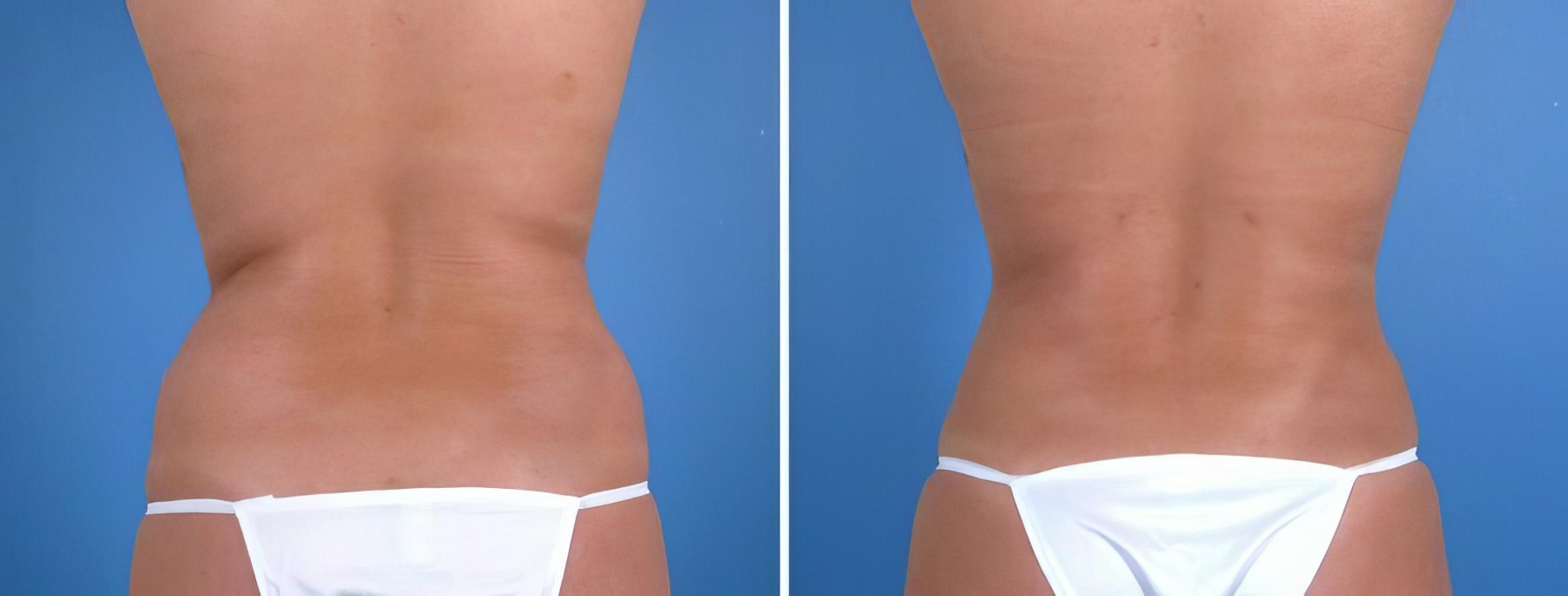 Liposuction Before & After Case 18040